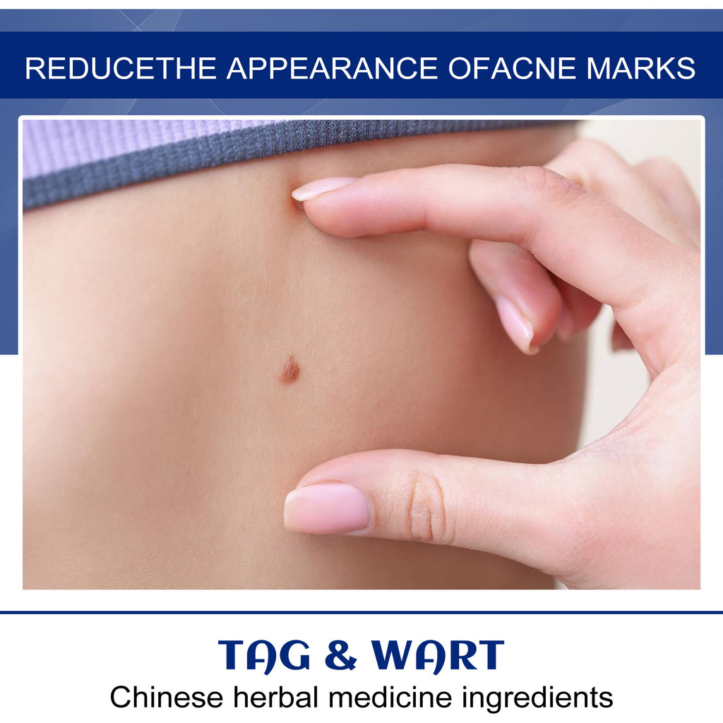 Advanced Tag & Wart Removal Cream – Fast-Acting Smoothing & Skin Clearing Formula